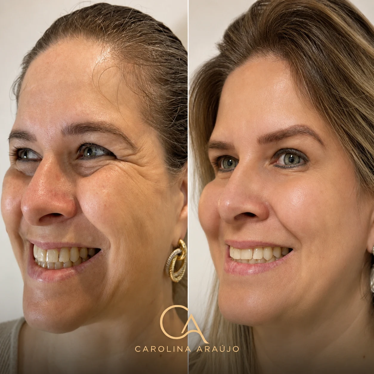 Antes e depois — caso 1