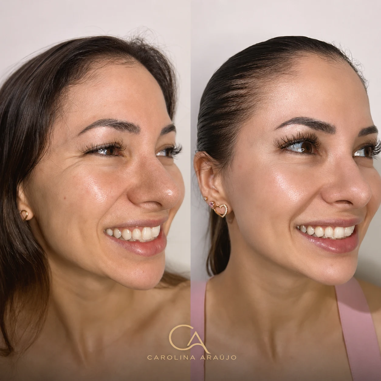 Antes e depois — caso 2