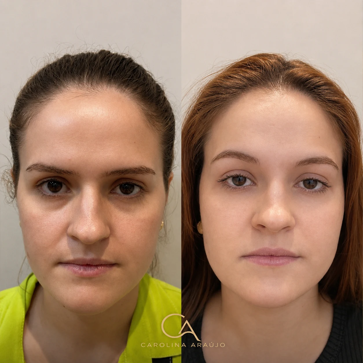 Antes e depois — caso 3