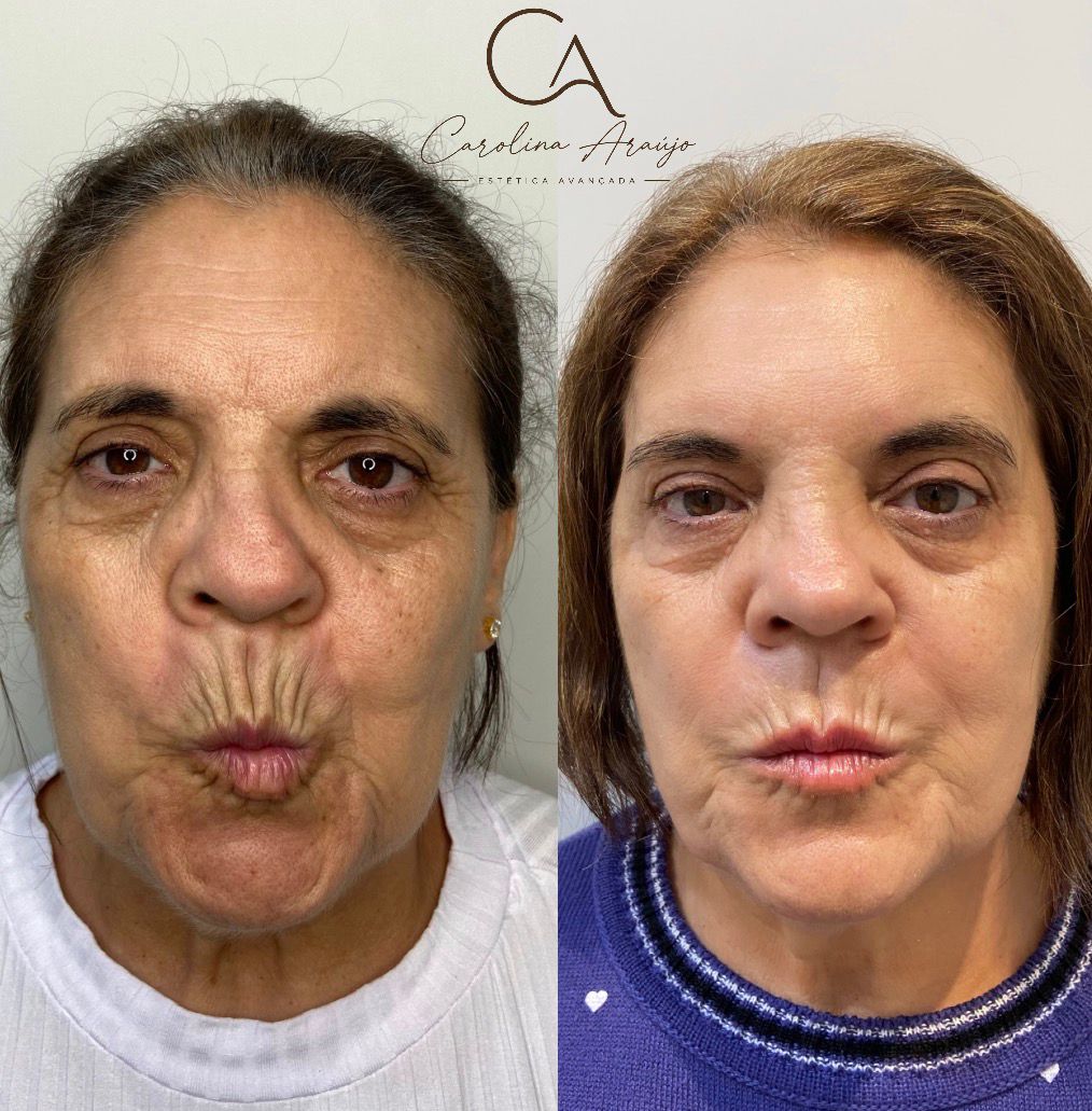 Antes e depois — caso 4