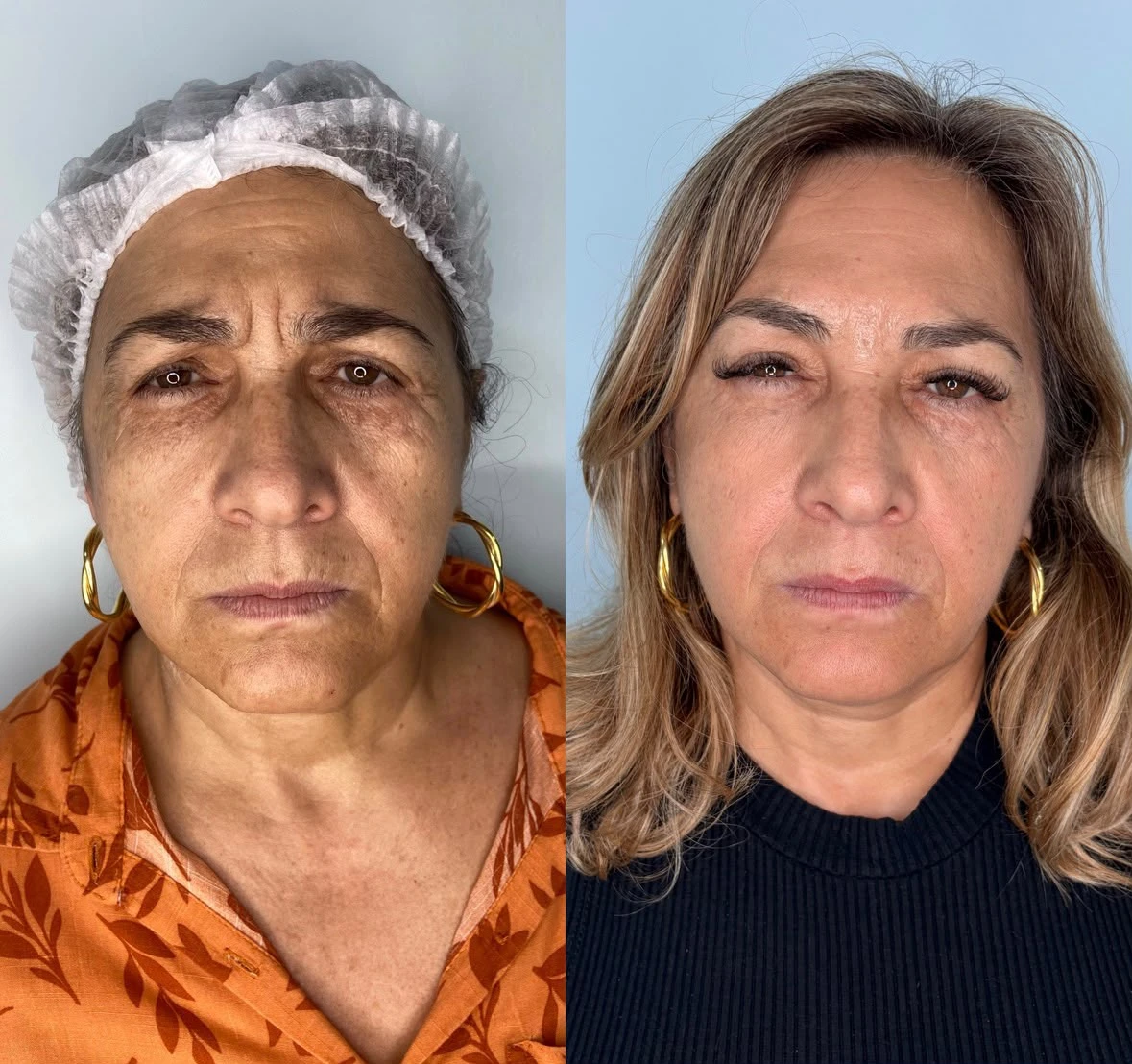 Antes e depois — caso 7, Frente